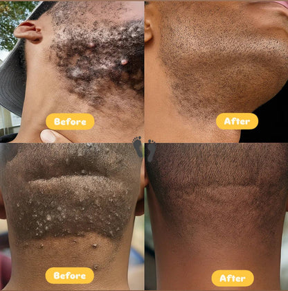 Roll-On Anti Poils Incarnés™ – Barbe, Visage, Maillot et Corps