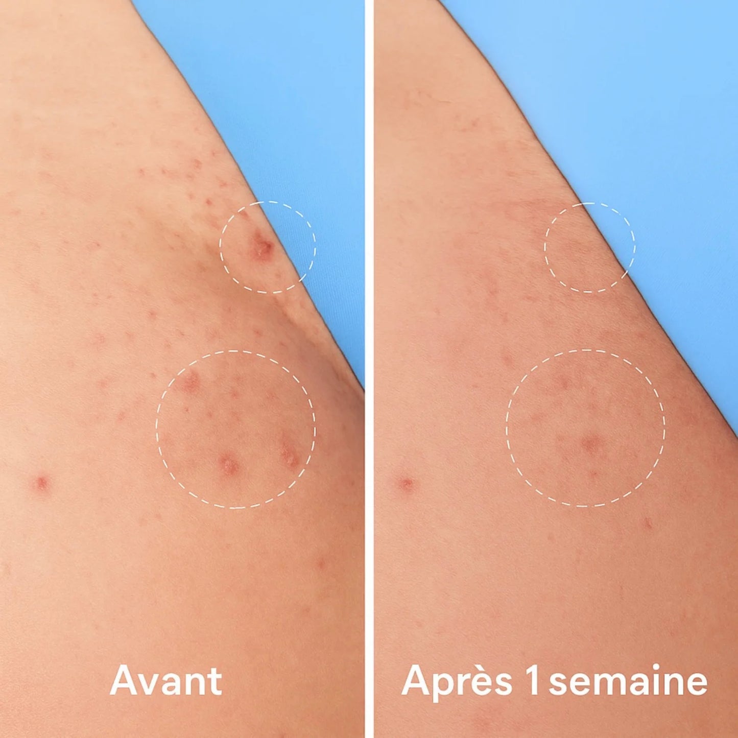 Roll-On Anti Poils Incarnés™ – Barbe, Visage, Maillot et Corps