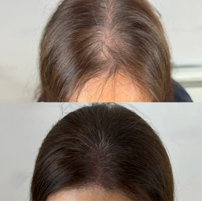 Sérum roll-on pour la croissance des cheveux