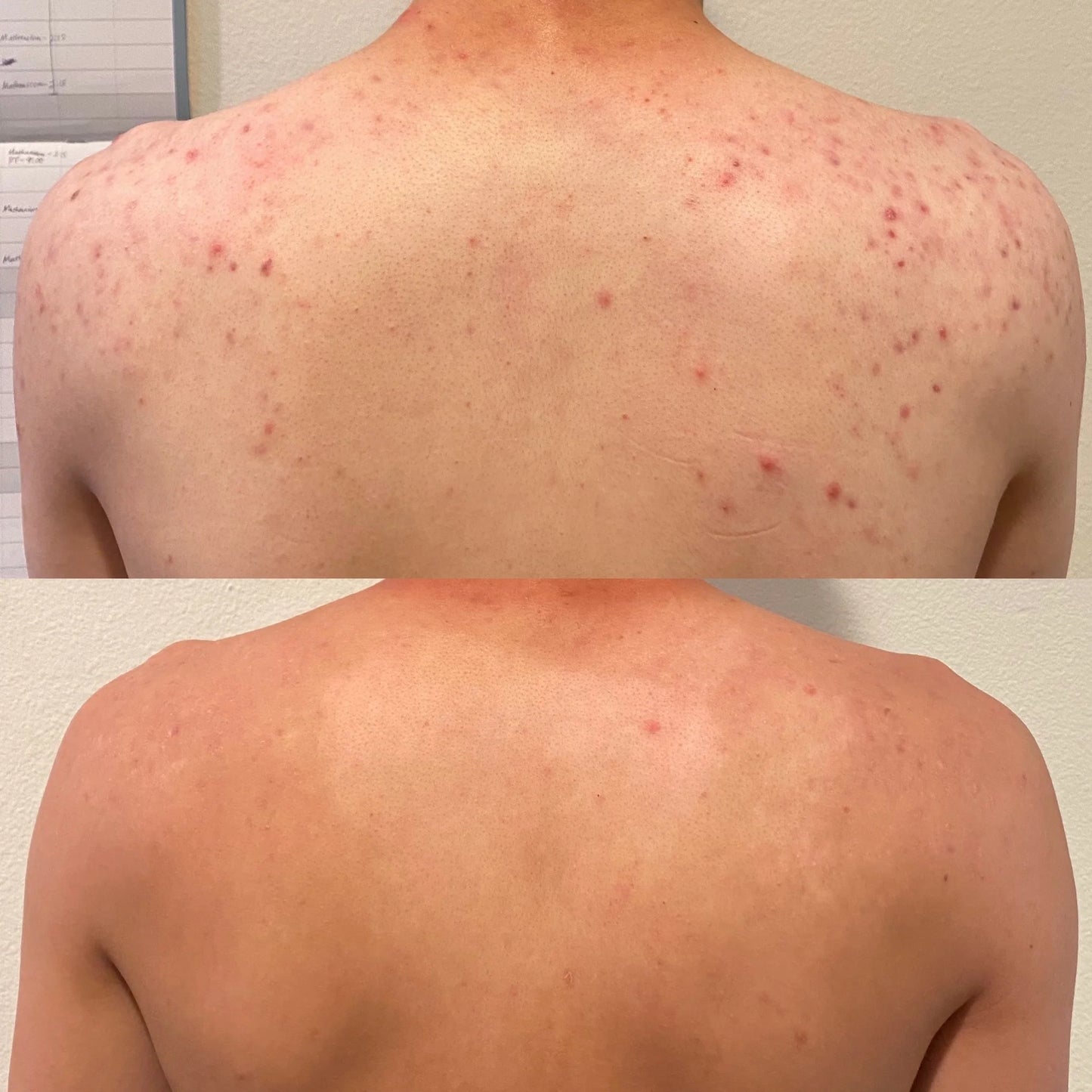 PanOxyl Nettoyant moussant contre l'acné, Peroxyde de benzoyle 10 %